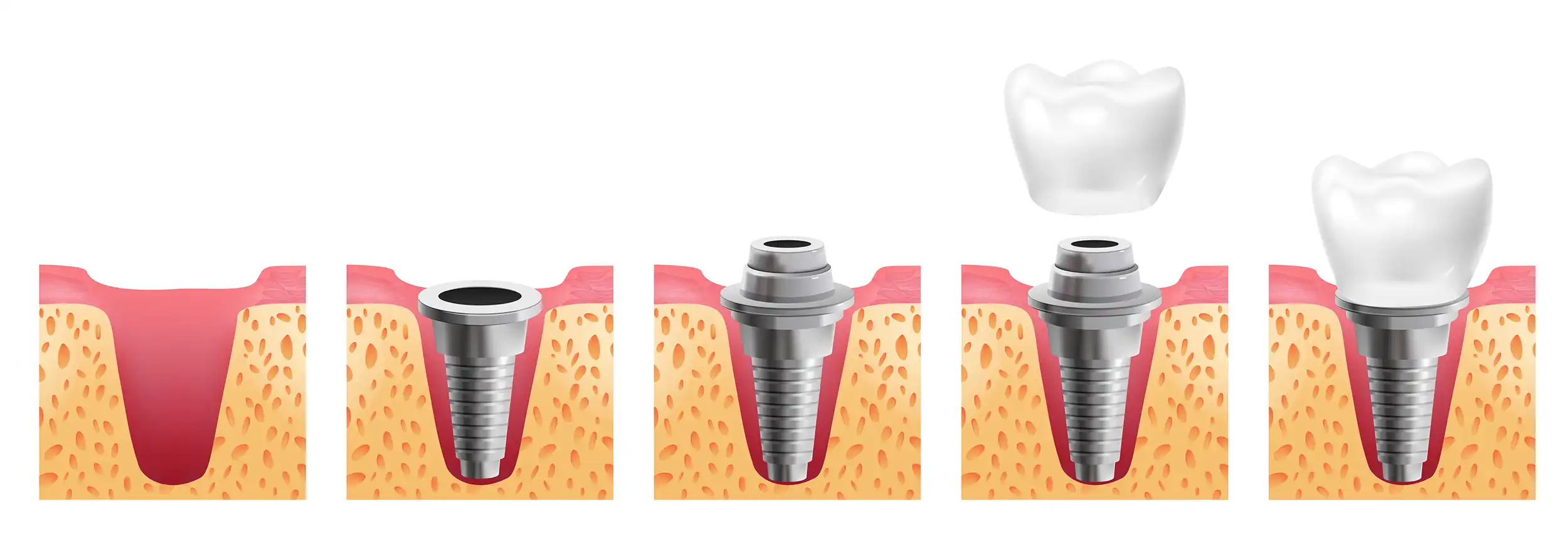 Estágios de aplicação dos Implantes Dentários Estágios de aplicação dos Implantes Dentários